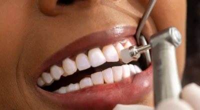 Close-up de atendimento odontológico com polimento dental