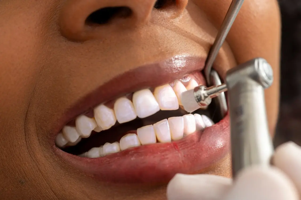 Close-up de atendimento odontológico com polimento dental