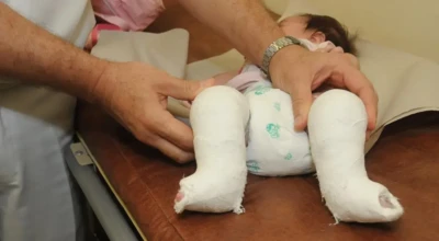 Bebê deitado em maca, usando fralda, com os dois pés e pernas engessados até abaixo dos joelhos. Um profissional de saúde ajusta os gessos com as mãos.