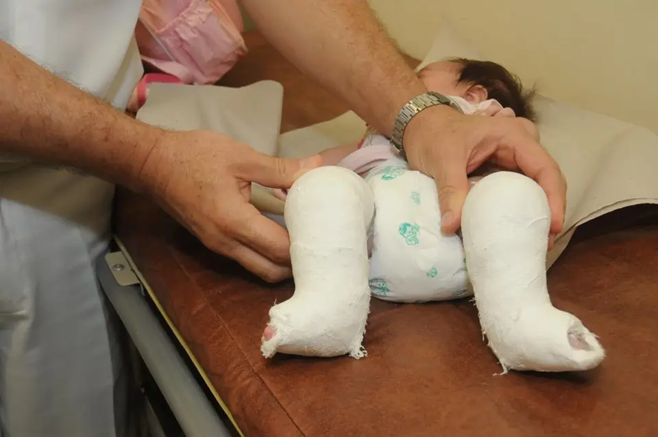 Bebê deitado em maca, usando fralda, com os dois pés e pernas engessados até abaixo dos joelhos. Um profissional de saúde ajusta os gessos com as mãos.